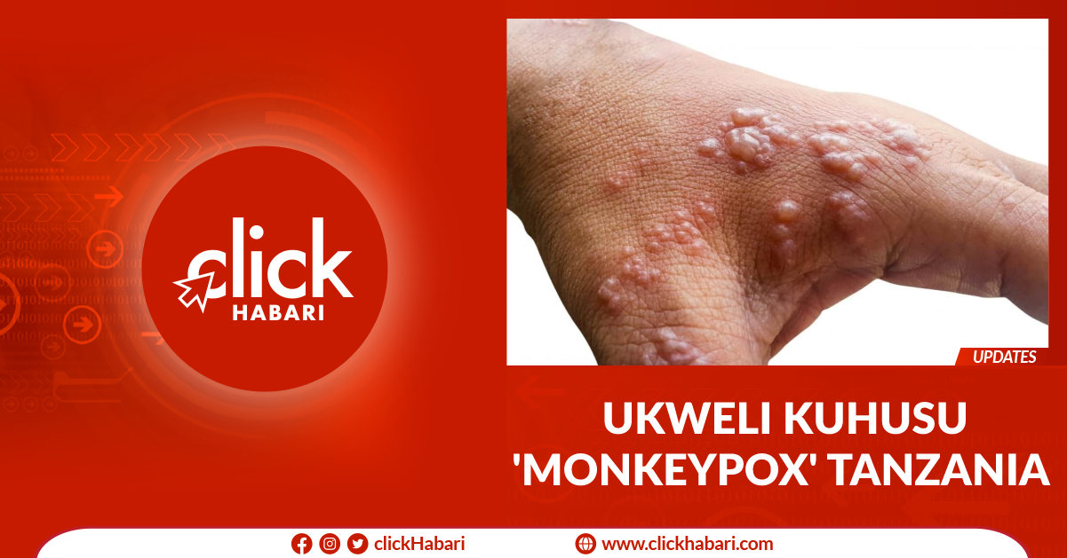 Ukweli kuhusu ‘Monkeypox’ Tanzania
